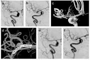 The Prospective Profile of Endovascular Coiling of Cerebral Aneurysms: The Impact of Clinical Presentation, Procedural Results, Aneurysm Rupture and Location